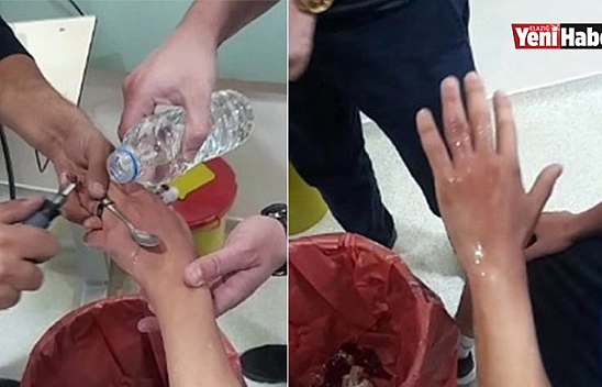 Elazığ İtfaiyesinden Yüzük Çıkarma Operasyonu!