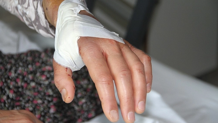 Kapalı diyaliz fistülü ilk defa el üstü çukurundan açıldı