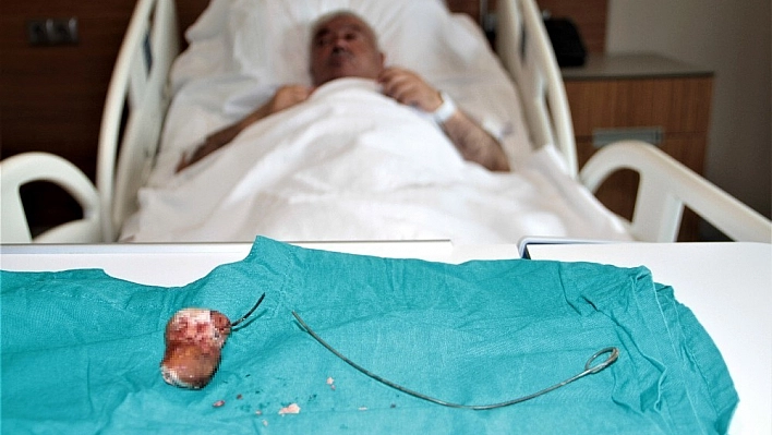 7 Yıl Sonra Farkedilen, Stent'in Hikayesi