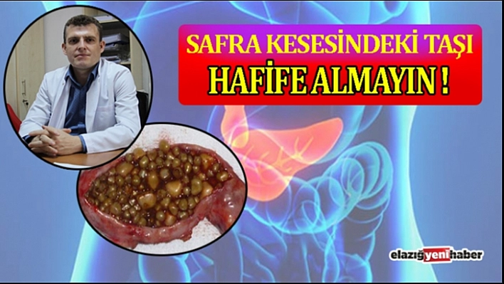 Safra Kesesinde Taş Olanlar için Önemli